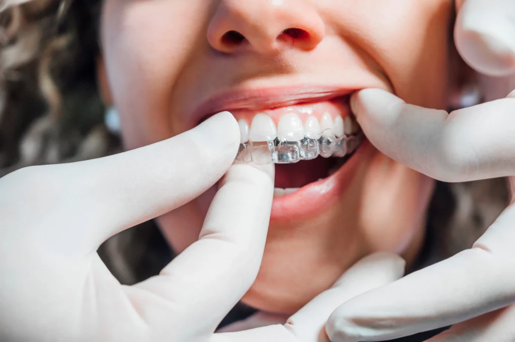 Close-up of hands adjusting clear dental aligner on teeth | 24th Street Dental in Phoenix, AZ