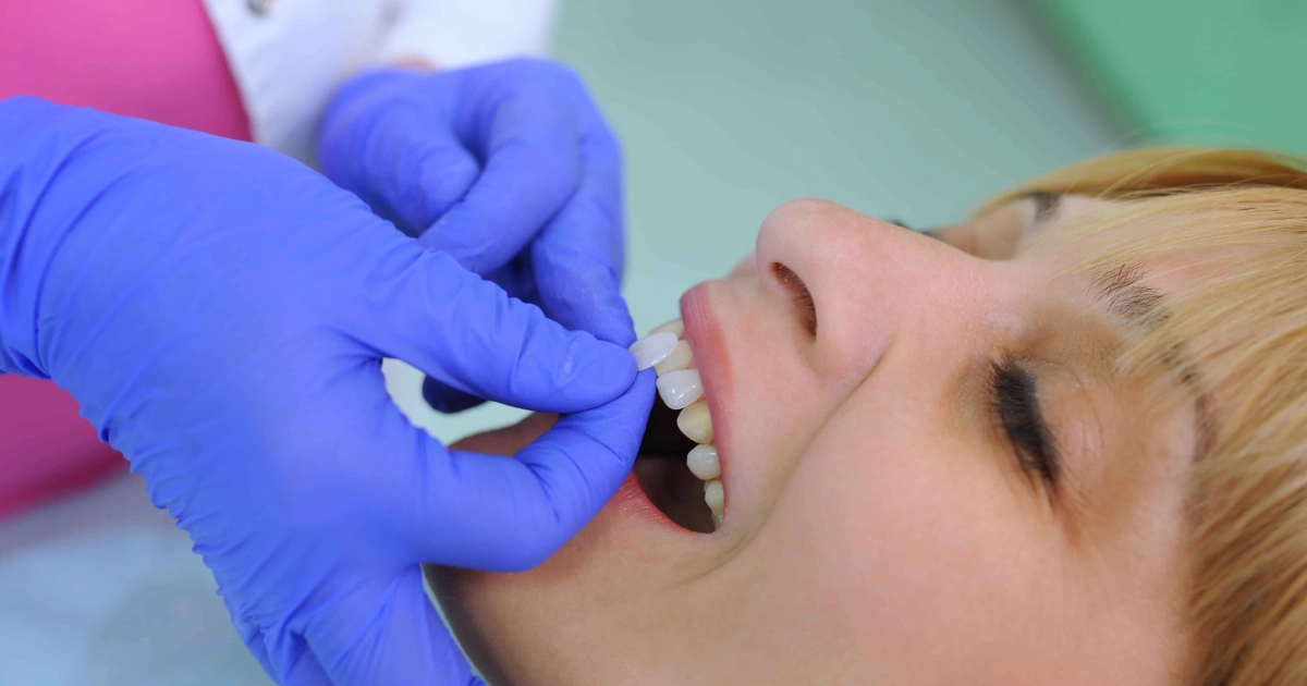 A dentist in Phoenix, AZ, holds a porcelain veneer near a patient’s mouth, checking fit or shade. Background is blurred, focus on the procedure.
