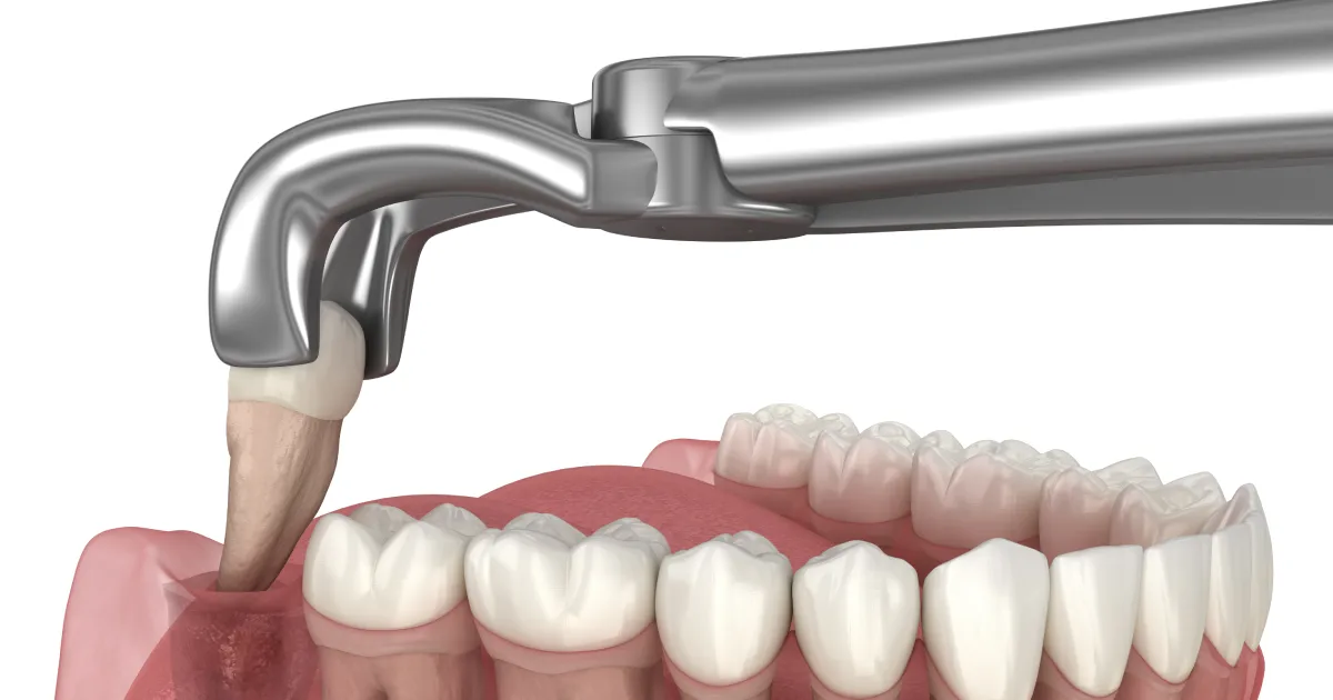 showing a Wisdom Tooth Extraction in phoenix, AZ
