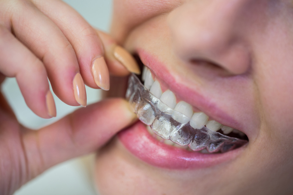 Invisalign® Aligners | 24th Street Dental Biltmore.psd