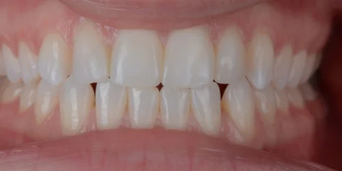 Close-up of teeth after cosmetic bonding in phoenix, AZ | 24th Street Dental Biltmore