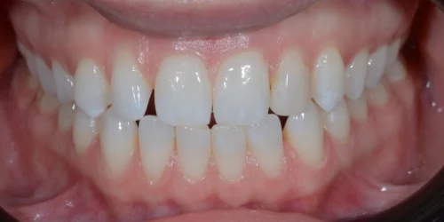 Close-up of teeth before Cosmetic Bonding in phoenix, AZ | 24th Street Dental Biltmore