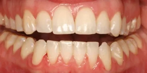 Close-up of teeth after Invisalign treatment at 24th Street Dental in Phoenix, AZ