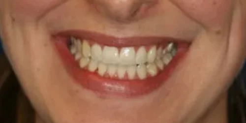 Close-up of teeth after Invisalign treatment at 24th Street Dental in Phoenix, AZ