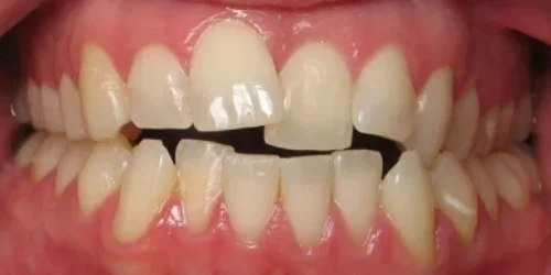Close-up of teeth before Invisalign treatment at 24th Street Dental in Phoenix, AZ