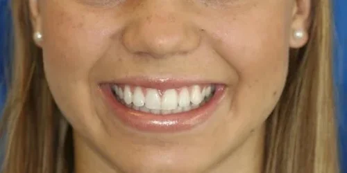 Close-up of teeth treatment images showcasing dental health improvement at 24th Street Dental in Phoenix, AZ.