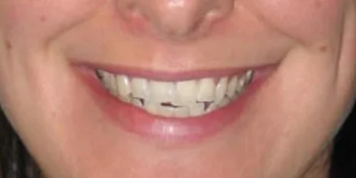 Close-up of teeth before Invisalign treatment at 24th Street Dental in Phoenix, AZ.