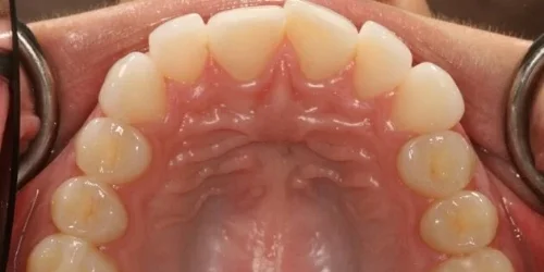Close-up view of upper teeth before Invisalign treatment at 24th Street Dental in Phoenix, AZ.