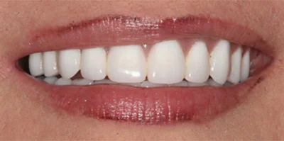 Close-up of teeth after treatment in Phoenix, AZ | 24th Street Dental Biltmore