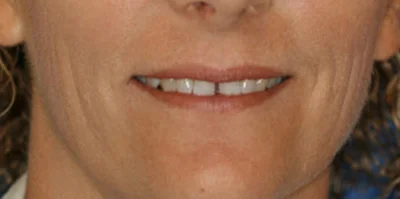 Close-up of teeth before treatment in Phoenix, AZ | 24th Street Dental Biltmore