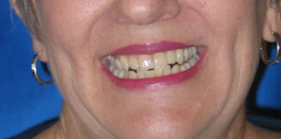 Close-up of teeth before treatment in Phoenix, AZ | 24th Street Dental Biltmore