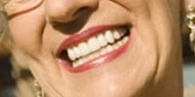 Close-up of teeth after treatment in Phoenix, AZ | 24th Street Dental Biltmore