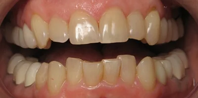 Close-up of teeth before treatment in Phoenix, AZ | 24th Street Dental Biltmore