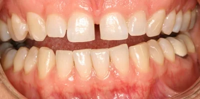 Close-up of teeth before treatment in Phoenix, AZ | 24th Street Dental Biltmore