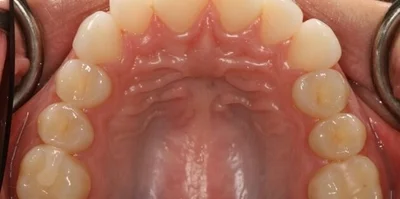 Close-up of teeth after treatment in Phoenix, AZ | 24th Street Dental Biltmore