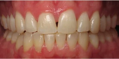 Patient teeth transformation through professional dental care in Phoenix, AZ | 24th Street Dental Biltmore