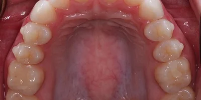 Close-up of teeth before treatment in Phoenix, AZ | 24th Street Dental Biltmore