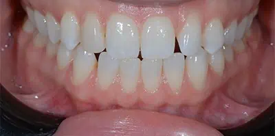Close-up of teeth before treatment in Phoenix, AZ | 24th Street Dental Biltmore