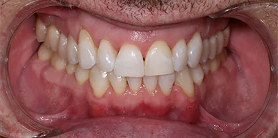 Close-up of teeth after treatment in Phoenix, AZ | 24th Street Dental Biltmore