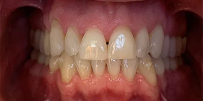Close-up of teeth before treatment in Phoenix, AZ | 24th Street Dental Biltmore