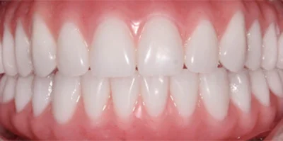 Close-up of teeth after treatment in Phoenix, AZ | 24th Street Dental Biltmore
