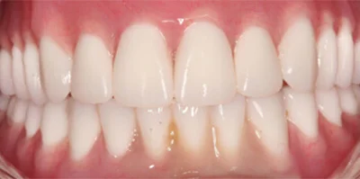 Close-up of teeth before treatment in Phoenix, AZ | 24th Street Dental Biltmore