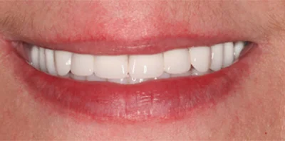 Patient teeth transformation through professional dental care in Phoenix, AZ | 24th Street Dental Biltmore