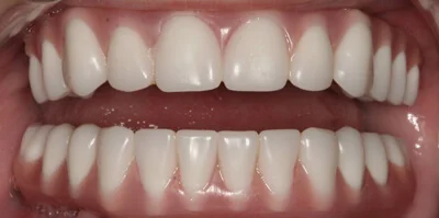 Close-up of teeth after treatment in Phoenix, AZ | 24th Street Dental Biltmore
