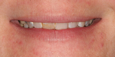 Close-up of teeth before treatment in Phoenix, AZ | 24th Street Dental Biltmore