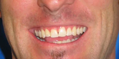 Patient teeth transformation through professional dental care in Phoenix, AZ | 24th Street Dental Biltmore