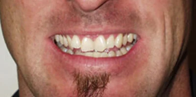 Patient teeth transformation through professional dental care in Phoenix, AZ | 24th Street Dental Biltmore