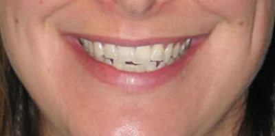 Patient teeth transformation through professional dental care in Phoenix, AZ | 24th Street Dental Biltmore
