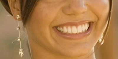 Patient teeth transformation through professional dental care in Phoenix, AZ | 24th Street Dental Biltmore
