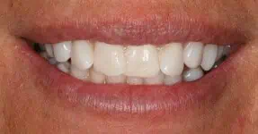Close-up of teeth before treatment in Phoenix, AZ | 24th Street Dental Biltmore