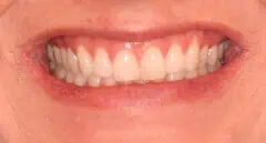 Close-up of teeth dental treatment in Phoenix, AZ | 24th Street Dental Biltmore