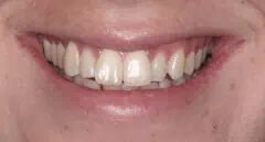 Close-up of teeth dental treatment in Phoenix, AZ | 24th Street Dental Biltmore