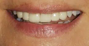 Smile with dental veneers applied in Phoenix, AZ | 24th Street Dental Biltmore