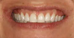 Close-up of teeth dental treatment in Phoenix, AZ | 24th Street Dental Biltmore