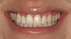 Close-up of teeth dental treatment in Phoenix, AZ | 24th Street Dental Biltmore