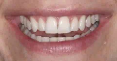 Close-up of teeth after treatment in Phoenix, AZ | 24th Street Dental Biltmore