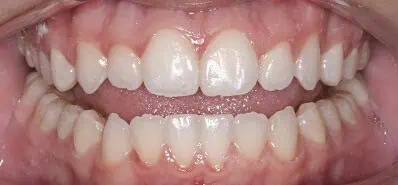 Close-up of teeth after treatment in Phoenix, AZ | 24th Street Dental Biltmore