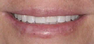 Close-up of teeth after treatment in Phoenix, AZ | 24th Street Dental Biltmore