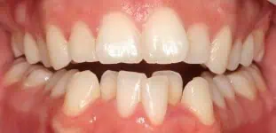 Close-up of teeth before treatment in Phoenix, AZ | 24th Street Dental Biltmore