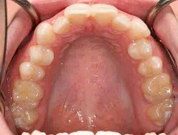 Close-up of teeth before treatment in Phoenix, AZ | 24th Street Dental Biltmore
