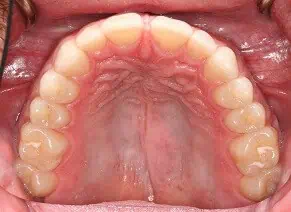 Close-up of teeth before treatment in Phoenix, AZ | 24th Street Dental Biltmore