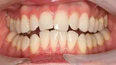 Close-up of teeth before treatment in Phoenix, AZ | 24th Street Dental Biltmore