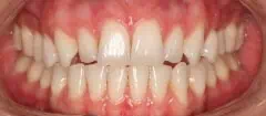 Close-up of teeth before treatment in Phoenix, AZ | 24th Street Dental Biltmore