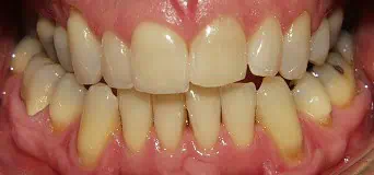 Yellow stained teeth before cleaning | 24th Street Dental Biltmore in Phoenix, AZ