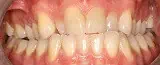 Plaque buildup on teeth close-up in Phoenix, AZ | 24th Street Dental Biltmore