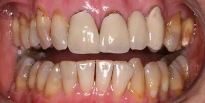 Severely stained teeth before treatment in Phoenix, AZ | 24th Street Dental Biltmore